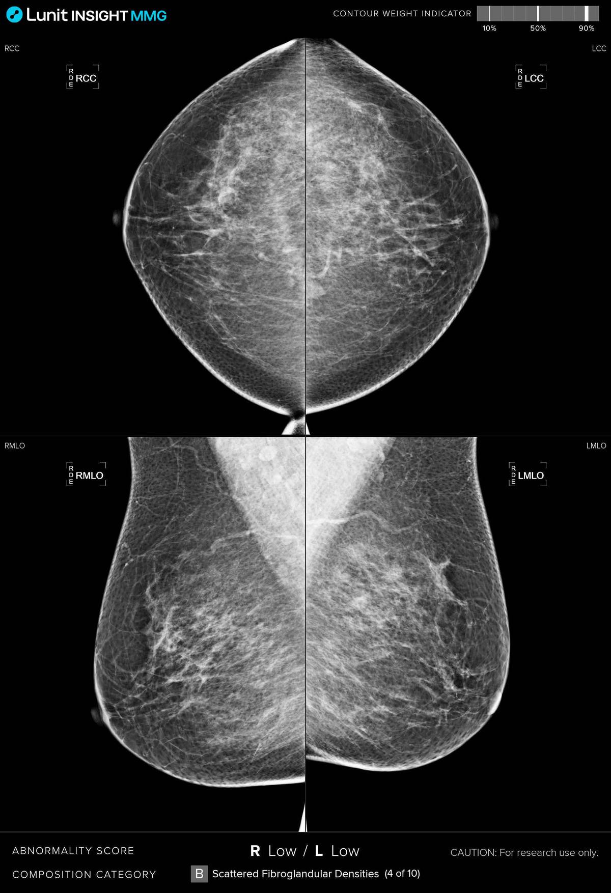 Lunit’s AI Boosts Qatar’s Breast Cancer Screening Program